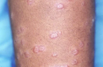 Top 5 Natural Remedies to Manage Sarcoidosis Symptoms Effectively