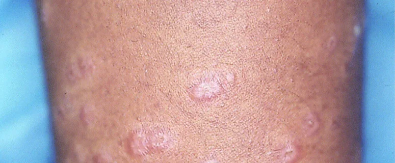 Top 5 Natural Remedies to Manage Sarcoidosis Symptoms Effectively