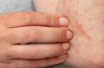 7 Effective Home Remedies to Relieve Skin Allergy Itching Naturally
