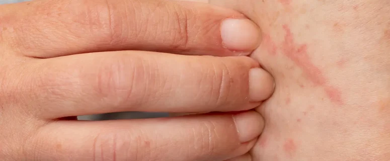 7 Effective Home Remedies to Relieve Skin Allergy Itching Naturally